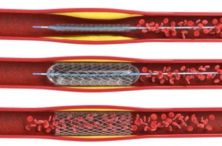 Bacak Atar Damar Tıkanıklığı: Perferik Arter Hastalığı ve Girişimsel Tedavi Yöntemleri