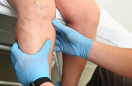 Varis ve Kapalı Yöntem ile Tedavisi