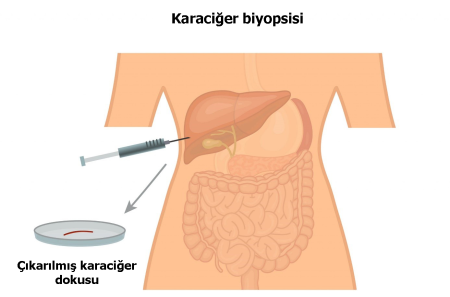 İnce ve Kalın İğne Biyopsileri: Yöntemler, Uygulamalar ve Klinik Önemi