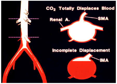 Karbondioksitli Anjiyografi: Güvenli ve Etkili Bir Alternatif