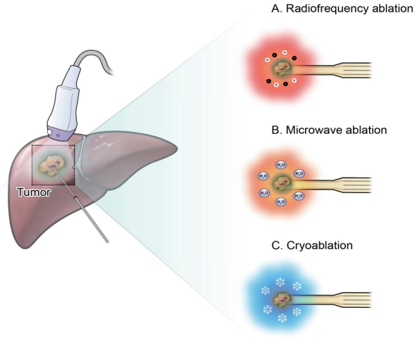 Tumor Treatment with Radiofrequency Ablation and Microwave Ablation