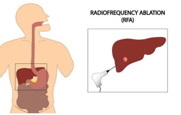 Tumor Treatment with Radiofrequency Ablation and Microwave Ablation