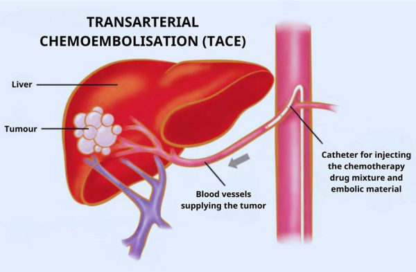 Interventional Treatment Method for Liver Cancer: Transarterial Chemoembolization (TAKE)