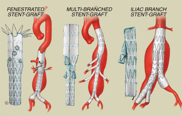 Abdominal Aortic Aneurysm and Interventional Treatment Methods