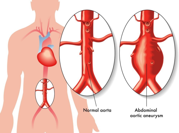 Abdominal Aortic Aneurysm and Interventional Treatment Methods
