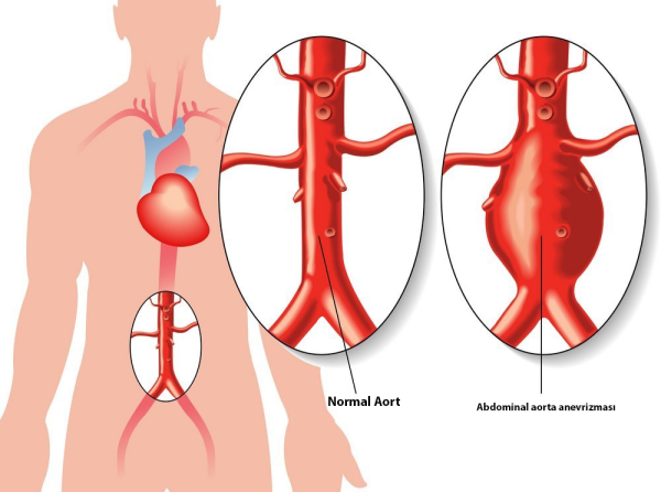 Abdominal Aort Anevrizması ve Girişimsel Tedavi Yöntemleri