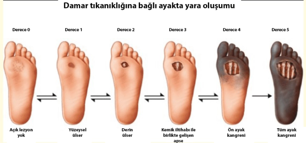 Diyabetik Ayak, Tedavi Yöntemleri ve Multidisipliner Yaklaşım