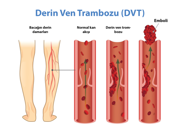Derin Ven Trombozu, Belirtiler ve Anjiyo ile Tedavisi