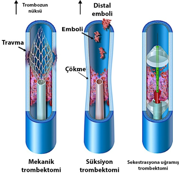 Derin Ven Trombozu, Belirtiler ve Anjiyo ile Tedavisi