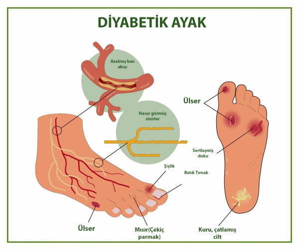 Diyabetik Ayak, Tedavi Yöntemleri ve Multidisipliner Yaklaşım