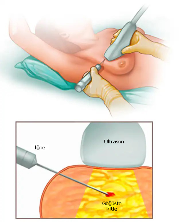 İnce ve Kalın İğne Biyopsileri: Yöntemler, Uygulamalar ve Klinik Önemi
