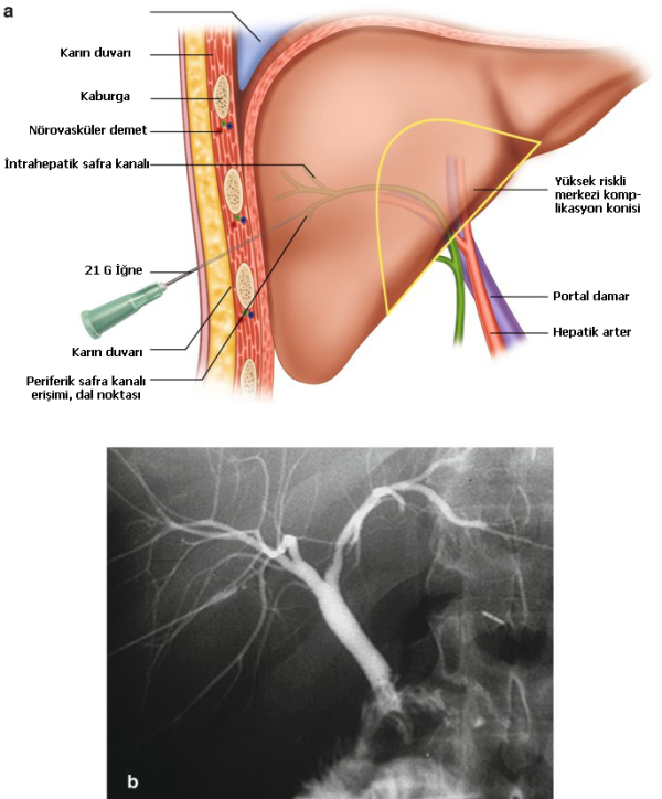Perkutan Transhepatik Kolanjiografi ve Perkütan Biliyer İşlemler: Temel Prensipler, Uygulama Alanları ve Yönetim